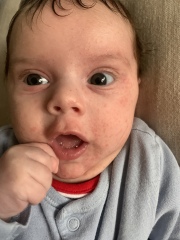 Baby acne/eczema or CMPA rash? Help pls.