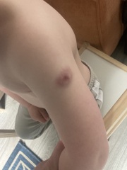 BCG scar popped 2nd time on my 4 month old's arm