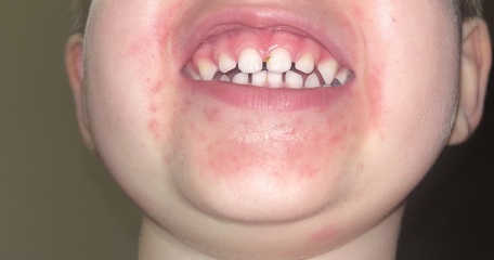 Rash around mouth