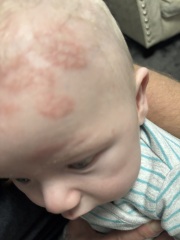 What is this on my sons head???
