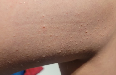 What's this rash?