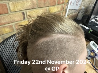 Hair Loss in an 11 year old