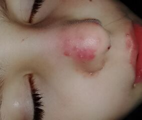 Child's skin infection on face and no one cares