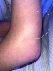 Swollen arm