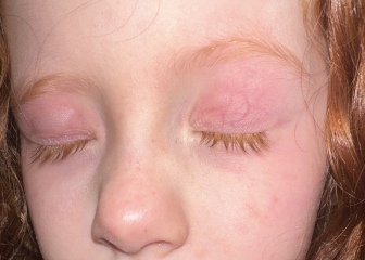 Swollen eye 3 year old