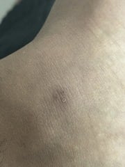 What bite mark is this? Bed bugs?