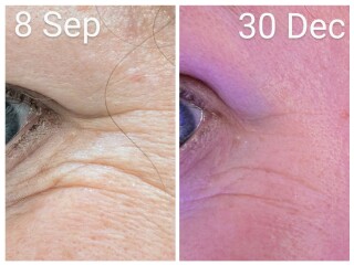 Tretinoin 0.006 - I think I can see an improvement already!! (Pic)