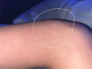 Swollen arm