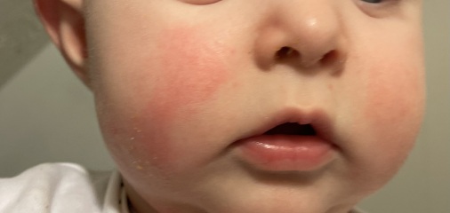 Allergy or teething?