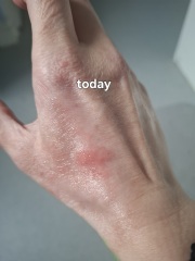 Hand infected (Warning, gross photos)
