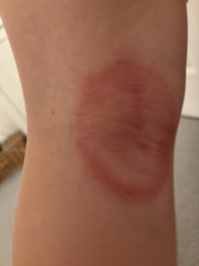 Eczema?