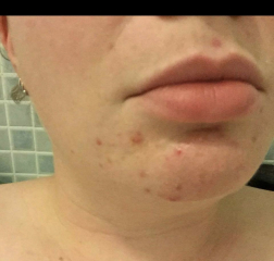 Acne on chin