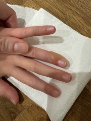 Cold sore and whitlow finger?!