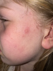 What is this!? Spot on face