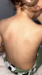 Swollen lymph nodes and rash in toddler?