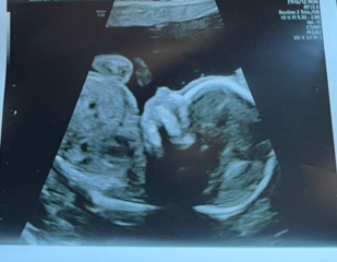 17 week skull theory ?