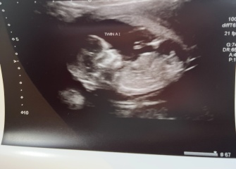 Twins gender 💙🩷