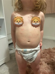 Could this be chicken pox?