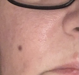 Anyone medical about? Family here for Christmas worried about a new bump on my face (photo)