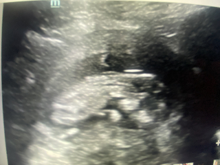 Nub theory pros, is this definitely a boy…?
