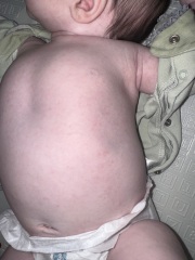 Rash check