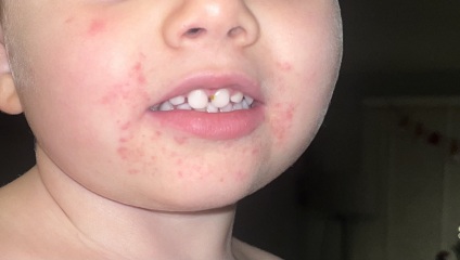 Rash around mouth