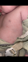 Rash check