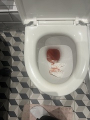 Panicking help, post c-section bleeding pics warning