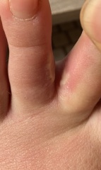 Is this Athletes Foot? Warning - pic