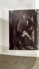 Pregnancy-Gender 12 week scan