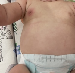 6 month old boy red, swollen nipple with bump