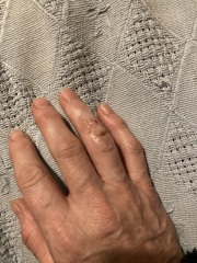 What am I supposed to do with this? Burnt finger; pic included