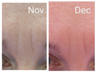 Tretinoin 0.006 - I think I can see an improvement already!! (Pic)