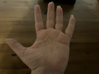 ALS/Hand Atrophy