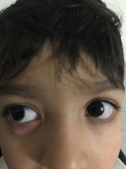 Chalazion 4 year old
