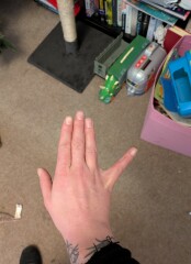 Have I dislocated my finger?! (Photo warning)