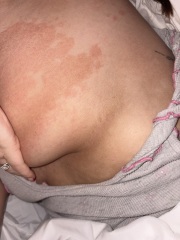 Breast cancer?