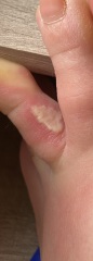 Is this Athletes Foot? Warning - pic