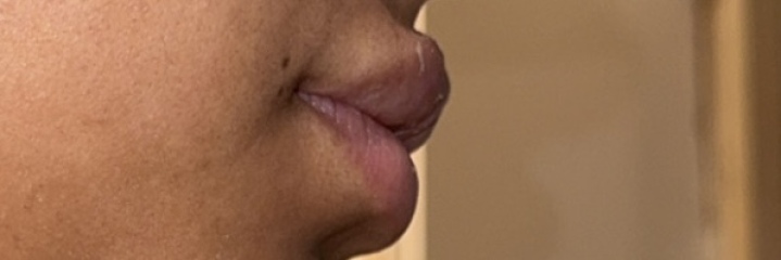 Uneven lip filler results ?!