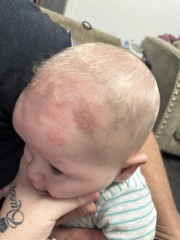 What is this on my sons head???