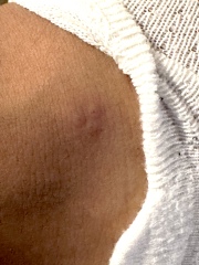 What bite mark is this? Bed bugs?