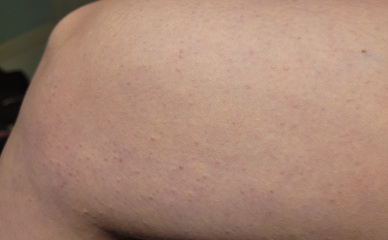 What's this rash?