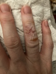 What am I supposed to do with this? Burnt finger; pic included