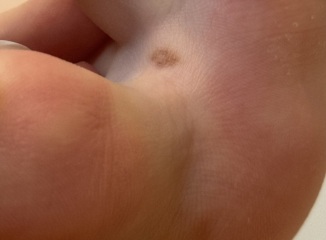 Abnormal moles?