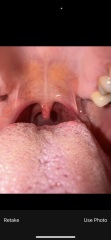Globas or more serious? Consistant swallowing