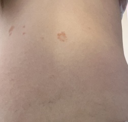 Caught ringworm from someone’s cat, should I post to Facebook