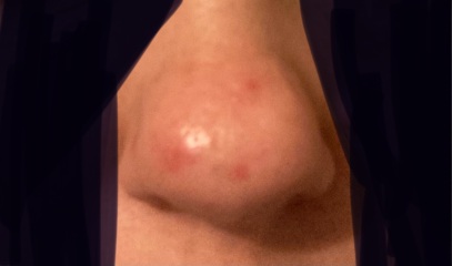 Skin problem