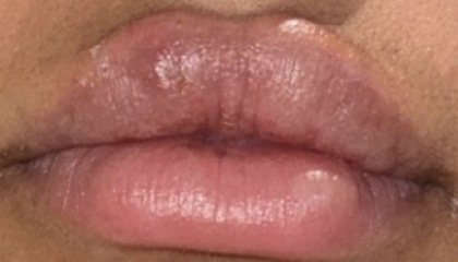 Uneven lip filler results ?!