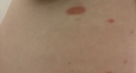 Caught ringworm from someone’s cat, should I post to Facebook