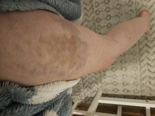 Large areas of bruising on thighs
